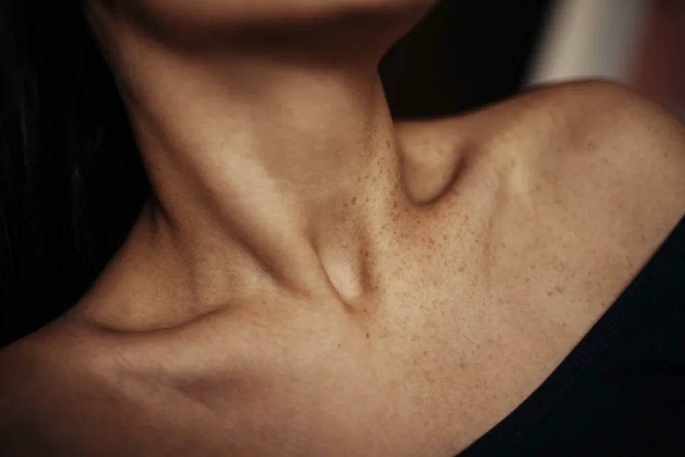 Neck and décolleté rejuvenation